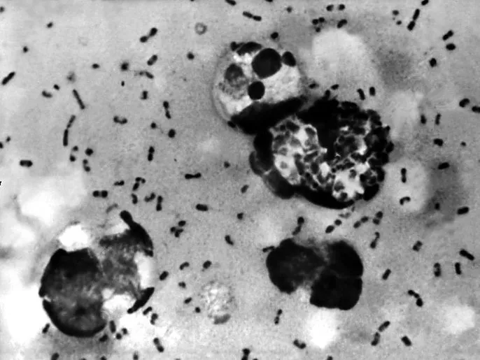 UNDATED PHOTO: A bubonic plague smear, prepared from a lymph removed from an adenopathic lymph node, or bubo, of a plague patient, demonstrates the presence of the Yersinia pestis bacteria that causes the plague in this undated photo. The F