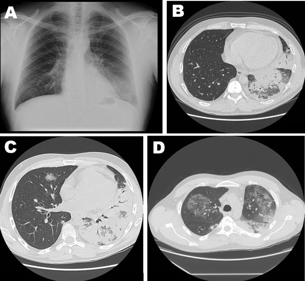 Chest X-ray showing bilateral pneumonia; inflamed lung areas appear lighter than healthy air-filled lungs
